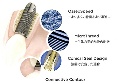 アストラテックインプラントシステムのイメージ