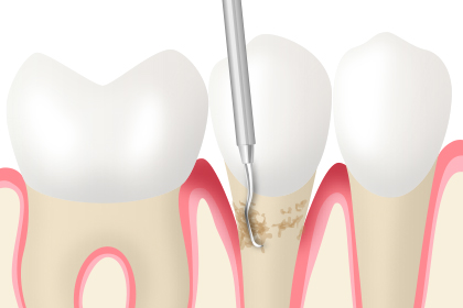 歯周病の治療イメージ